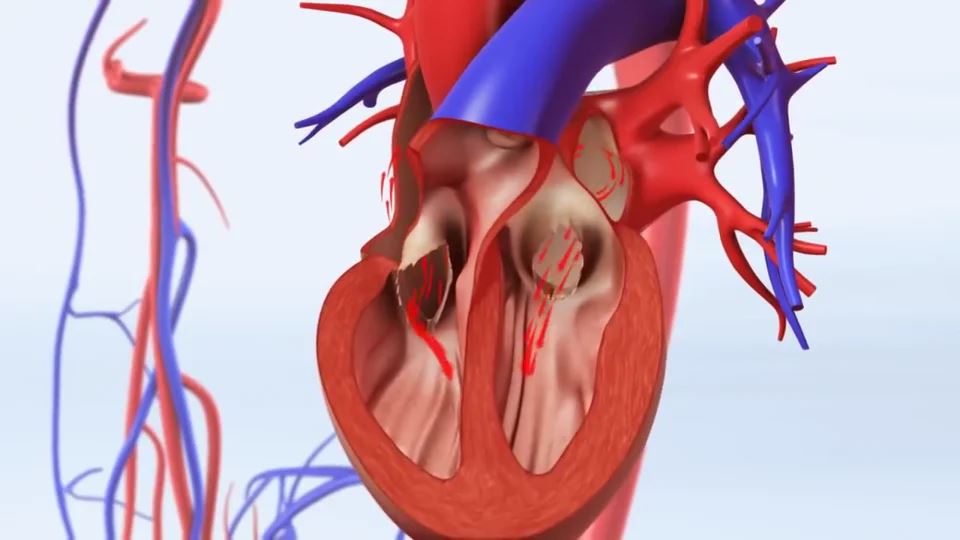 Atrial Fibrillation Explained